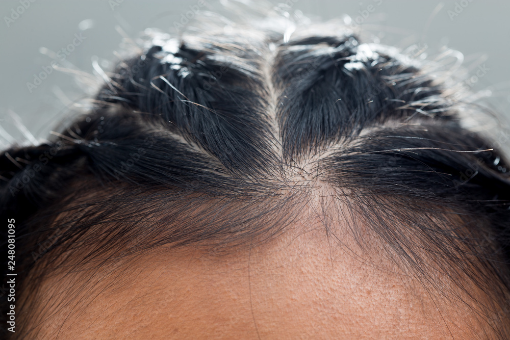 Wall mural Closeup macro portrait of female hair head part, Human woman open thin hair area on forehead to see natural skin wrinkle, root, scalp and problem