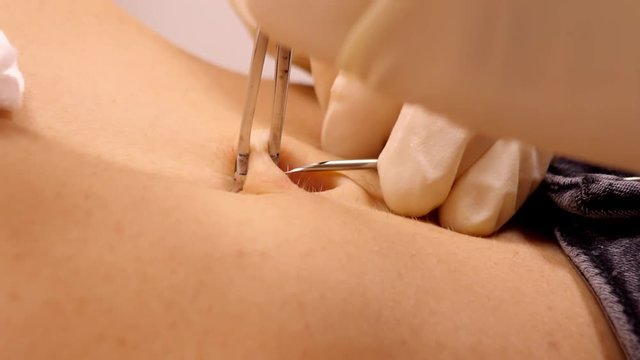 slow motion master holds clamps fixing navel tissue makes opening using beveled-tip hollow medical needle for piercing 