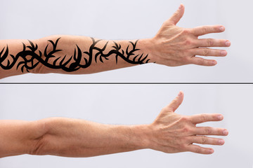 Laser Tattoo Removal On Man's Hand