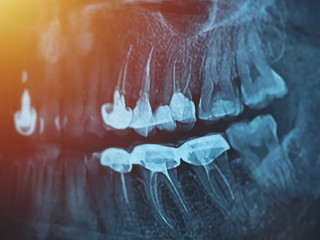 Dental xray for all teeth, side view