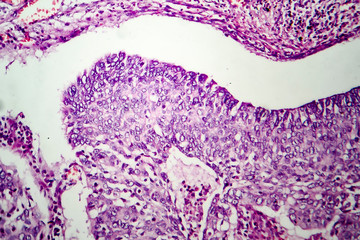 Lung adenocarcinoma, light micrograph, photo under microscope