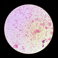 microscopic view of gonorrhea (Neisseria gonorrhoeae) 