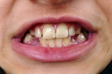 child's mouth and teeth, the arrival of new teeth instead of the teeth,