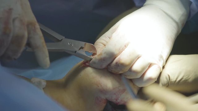 Surgeon bites off the excess bone with surgical nippers during the arm surgery (4K, 25fps)