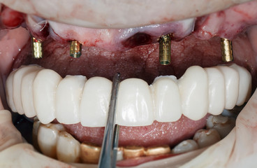 fitting a temporary prosthesis on the abutment of the upper jaw after surgery