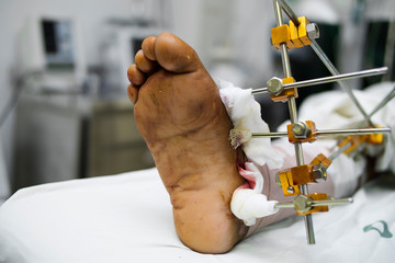 Patient with leg fracture