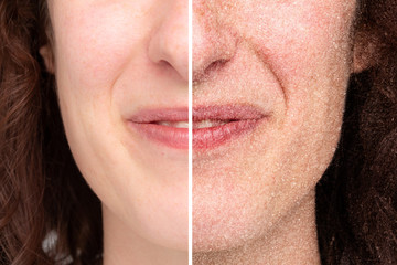 Rappresentation of woman hal face with dry skin, before and after beauty treatment