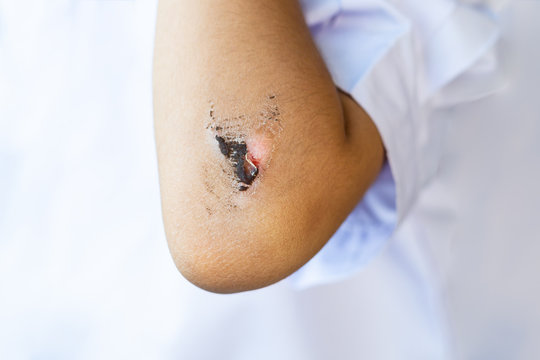 wound have scab on the elbow of the child