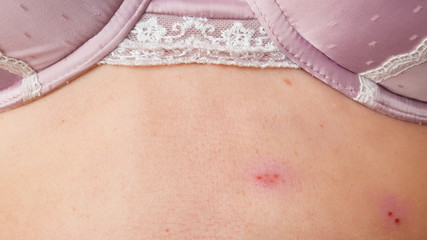 skin rash treatment on woman body. Shingles,  Disease, Herpes zoster, varicella-zoster virus. skin...