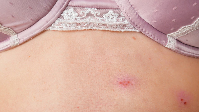 skin rash treatment on woman body. Shingles, Disease, Herpes zoster,  varicella-zoster virus. skin rash and blisters on body Stock Photo