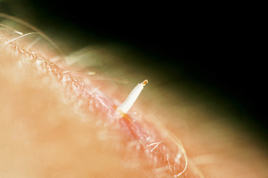 bot fly larvae inside flesh