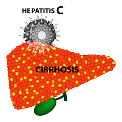 Hepatitis C leads to the development of cirrhosis in 97 percent of cases. Infographics. Vector illustration on isolated background