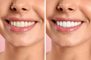 Smiling woman before and after teeth whitening procedure, closeup