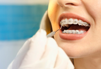 Closeup dental braces checkup 