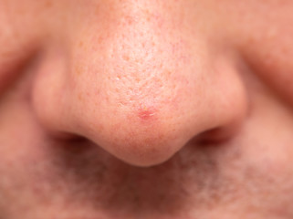 pimple on the nose