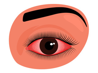 Vector illustration of irritated human eye with redness and blood vessels. For advertisement of drops and other medicines for eyes or medical publications