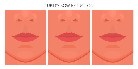 Vector illustration. Getting rid of upper lip Cupid’s bow on face before, after aesthetic plastic surgery. Close up view. For advertising of medicinal, cosmetic, procedures