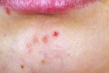 Female face with acne skin problem