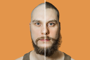 Man before and after hair loss, transplant on background