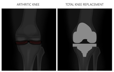 Vector illustration. Anatomy, front x-ray of an arthritic knee joint and a knee after total knee replacement. For advertising and medical publications