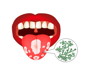 Oral thrush. Candidiasis on the tongue. Fungus in the mouth. Infographics. Vector illustration on isolated background.