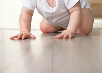 Cute little baby before and after allergy treatment crawling on floor indoors, closeup