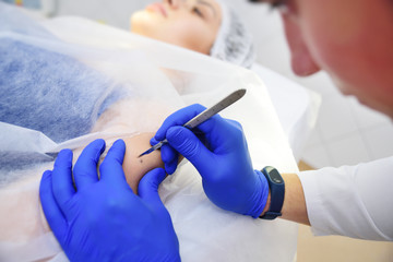 Medical surgical treatment removal of a mole on the hand of a young woman patient. Use of safe...