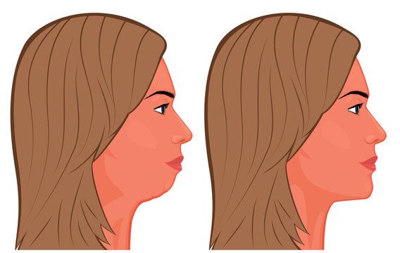 Vector illustration. A female face before, after plastic surgery - chin augmentation. Close up view. For advertising of plastic surgery, medical and beauty publications