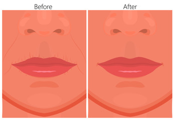 Vector illustration of upper-lip wrinkles removal before and after plastic surgery or cosmetic procedure. For advertising and beauty publications.
