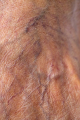 Skin Blood Varicose veins on foot in Senior women, Close up & Macro shot, Selective focus, Body part, Healthcare concept