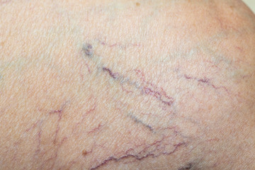 Fototapeta premium Varicose veins on a leg in Senior women, Close up & Macro shot, Selective focus, Asian body skin part, Healthcare concept