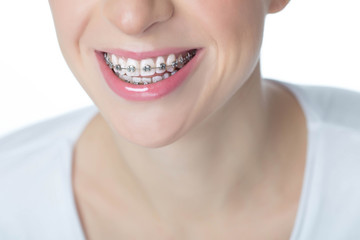 Woman with braces