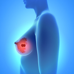3d illustration of breast cancer - Mammakarzinom