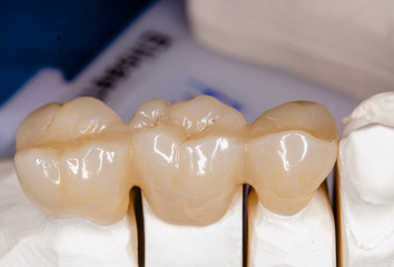 zirconia crowns on a plaster model, ready to be inserted