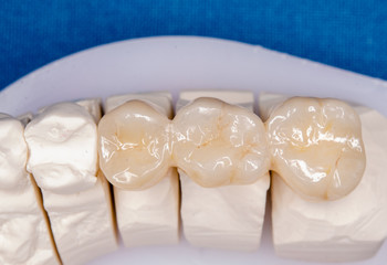 zirconia crowns on a plaster model, ready to be inserted