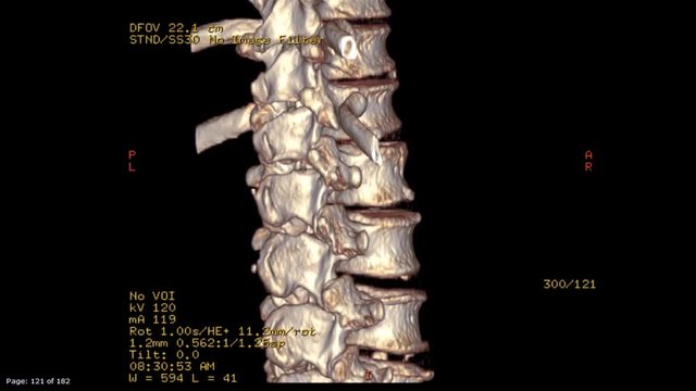 CT scan image of thoracolumbral spine or t-l spine   3D rendering image Rotating on monitor showing fracture of t12. medical concept