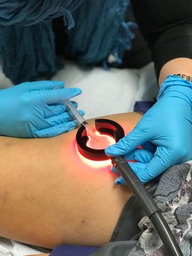 Sclerotherapy performed with Vein Light