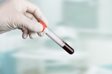 Hand mit medizinischem Handschuh hält eine Blutprobe im Labor