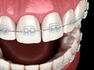 Teeth Clear braces in gums. Medically accurate dental 3D illustration