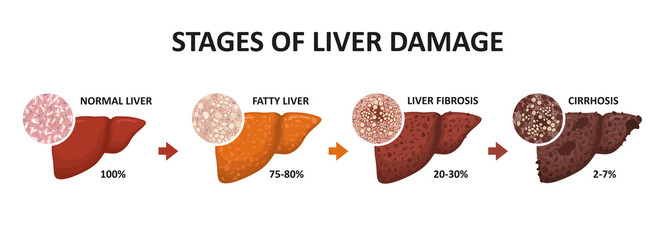 Stages of liver damage. Healthy, fatty, liver fibrosis and cirrhosis.