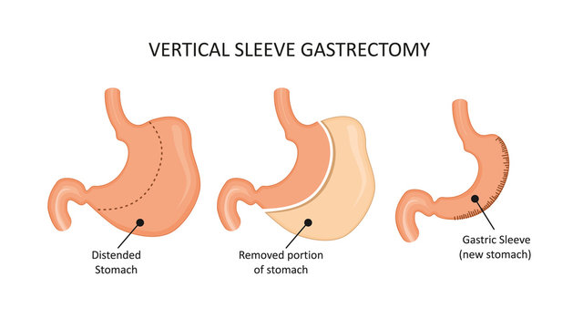 Vertical sleeve gastrectomy. Stomach reduction surgery