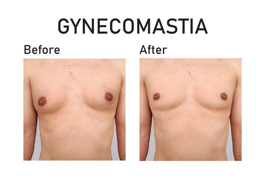 Gynecomastia. Before and after surgery