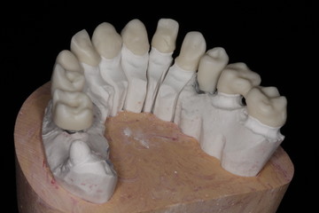 Zirconia on plaster