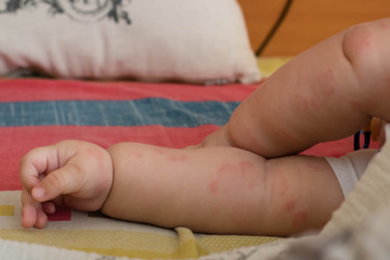 A young baby with hives