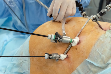 Endovideosurgery. Medical probes stuck in the belly of a fat patient. Surgery laparoscopy. Hand doctor in a white glove. Close-up.