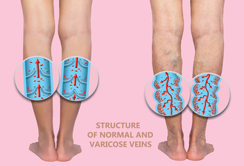 Varicose veins on a female senior legs. The structure of normal and varicose veins.