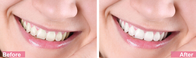 Smiling young woman before and after teeth whitening procedure, closeup