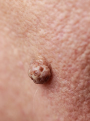 Fototapeta premium Elderly pensioner female, dermal fibroma closeup.