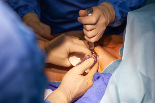 Proth&egrave;se mammaire