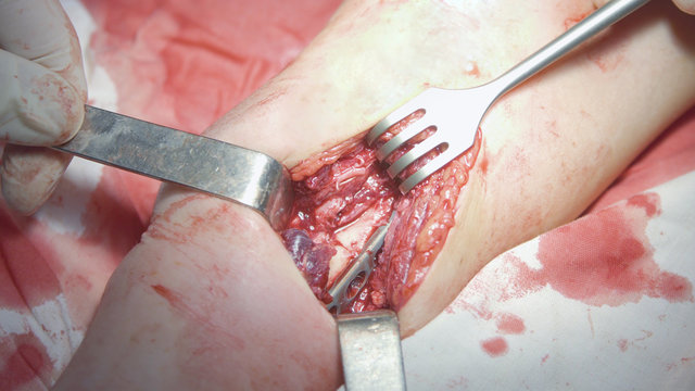 Ulna Bone And Screw Plate Closeup